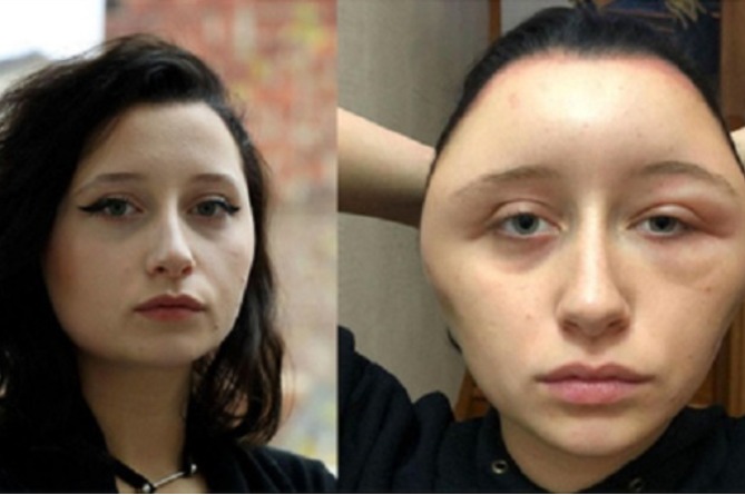19-летняя француженка чуть не погибла из-за краски для волос