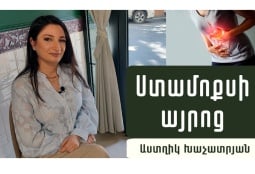 Ինչպե՞ս ազատվել այրոցից. գաստրոէնտերոլոգ Աստղիկ Խաչատրյանի խորհուրդները (ՎԻԴԵՈ)