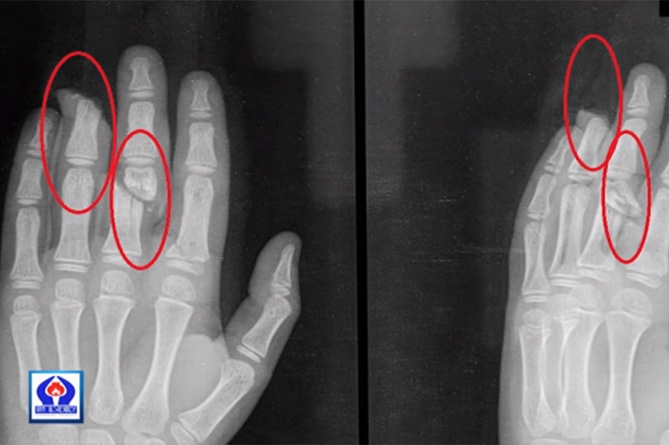 8 տարեկան երեխան փայտ է կոտրել ու վնասել 2 տարեկան եղբոր մատները (ՎԻԴԵՈ)