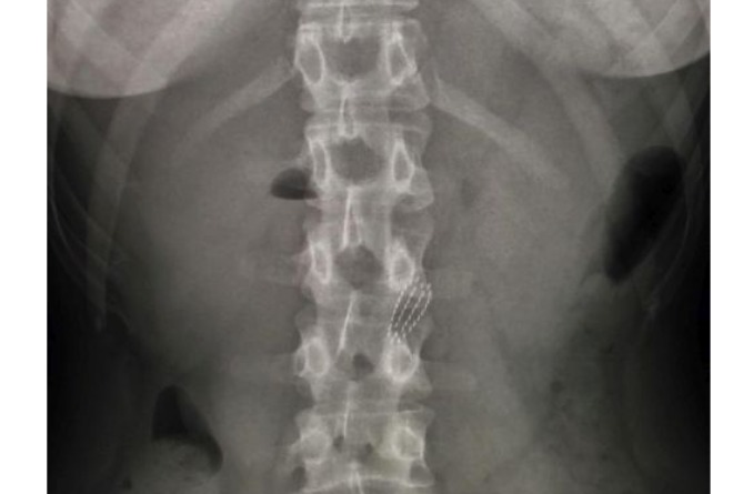 рентген зубная щетка в желудке