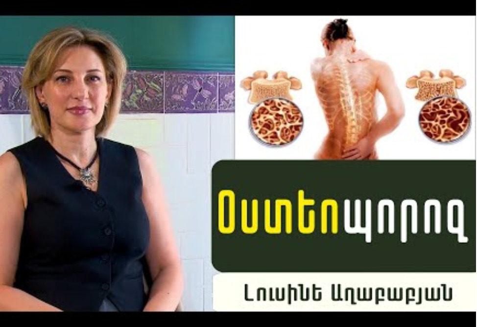 Օստեոպորոզի կանխարգելման 3 հզոր միջոց. Էնդոկրինոլոգ Լուսինե Աղաբաբյանի խորհուրդները (ՎԻԴԵՈ) Օստեոպորոզի կանխարգելման 3 հզոր միջոց. Էնդոկրինոլոգ Լուսինե Աղաբաբյանի խորհուրդները (ՎԻԴԵՈ)