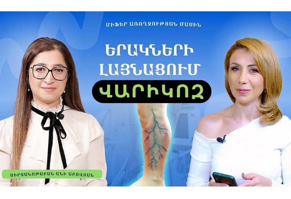 Վարիկոզի կանխարգելում և բուժում, ինչպես ազատվել ծանրության զգացողությունից. սիրտանոթաբան Անի Աբովյանի խորհուրդները (ՎԻԴԵՈ)