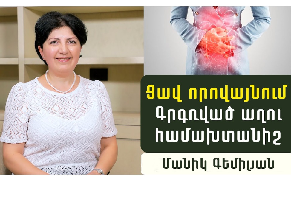 Գրգռված աղու համախտանիշ, ինչպե՞ս ախտորոշել և բուժել․ գաստրոէնտերոլոգ Մանիկ Գեմիլյանի խորհուրդները (ՎԻԴԵՈ)